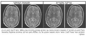 צילום הדמיה - שתי התמונות מימין מציגות חתכים סמוכים של המוח בהדמיית MRI, והשתיים משמאל הן גירסאות משופרות שלהן. הדמיון בין שני החתכים מנוצל לשיפור איכות התמונה וקיצור דרמטי של 85% במשך הסריקה. 