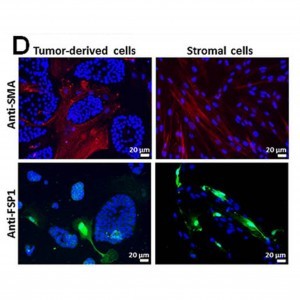 תאי סטרומה (צבועים באדום או בירוק) ותאים סרטניים (גרעיני התאים צבועים בכחול) שהופקו מגידול של סרטן הקיבה