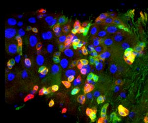 תמונה ממיקרוסקופ קונפוקלי: חתך במעי הזבוב הבוגר - עודף תאי אב (אדומים וירוקים) עקב אובדן בקרה של הזהות הממוינת של תאי מעי בוגרים