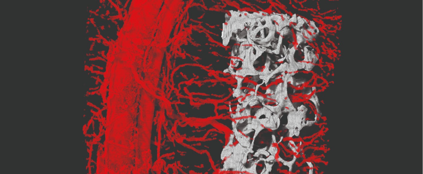 הצלחה ביצירת שתל מהונדס המחליף רקמות עצם פגועות