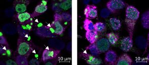 תאים המבטאים חלבון FUS עם מוטציה הגורמת למחלת ALS (מסומן בירוק). חלבון זה יוצר אגרגטים בתוך התאים (חיצים לבנים). כאשר מבטאים בנוסף את השפרון DNAJB14 (מסומן בוורוד, תמונה ימנית), התאים מייצרים הרבה פחות אגרגטים של FUS מוטנטי.