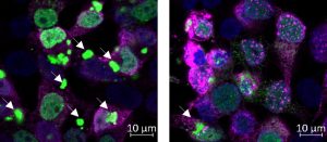 Cells expressing the protein FUS with an ALS-causative mutation (green). This protein generates aggregates within the cells (white arrows). When the chaperone DNAJB14 is co-expressed together with mutant FUS (pink, right panel), cells generate remarkably less FUS aggregates