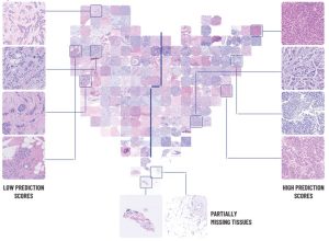 a. A 2D visualization of the image feature vectors by applying t-SNE. Each point represents a single patient in the BCCA test set. The t-SNE embedding maps patients with similar image features to near points, and patients with dissimilar image features to far points. The points are colored by the PD-L1 prediction scores of their corresponding patients. The 8 patients that were classified positive by the first pathologist and low-PS by the system are marked and their classifications by both pathologists are noted. b. The TMA images corresponding to the t-SNE embedding are presented. Several examples of low and high prediction score images are shown, to demonstrate the characteristics observed by the pathologists. Examples of partially missing tissues are shown at the bottom.