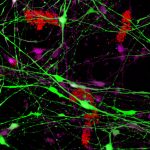תמונה מדעית. מערכת מודל תלת-ממדית של תאי עצב אנושיים בצלחת. בירוק ובסגול: תאי עצב המבטאים חלבון תקול במערכת האוביקוויטין. כתוצאה מביטוי זה נוצרת הפתולוגיה המאפיינת חולי אלצהיימר – היווצרות צבירי עמילואידים (באדום) מחוץ לתאים